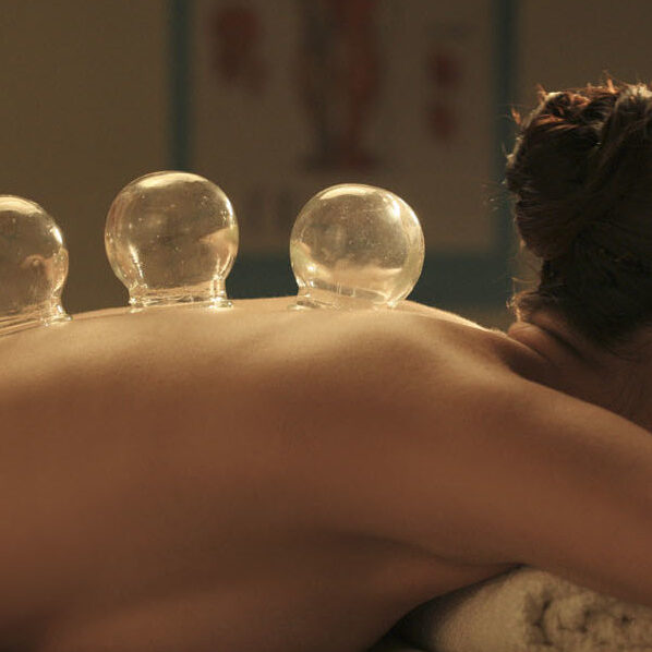 CUPPING CUPPING